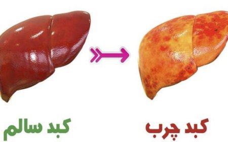 چه کسانی در معرض ابتلا به بیماری کبد چرب هستند؟