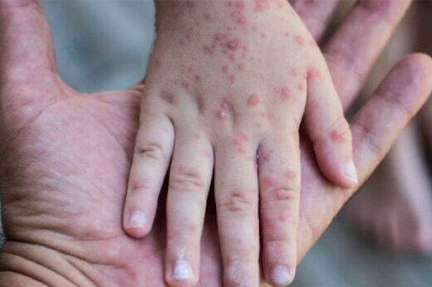 هشدار سرخک در فارس؛ شناسایی ۲۰ بیمار قطعی در میانه موج کنترل شده