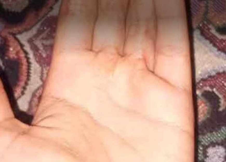 دست سوخته دخترروستایی؛ وقتی پول نیست، درمان هم نیست