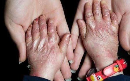 بیش از ۴۰ بیمار پروانه‌ای در خوزستان شناسایی شدند؛ تأمین پانسمان همچنان چالش‌برانگیز است